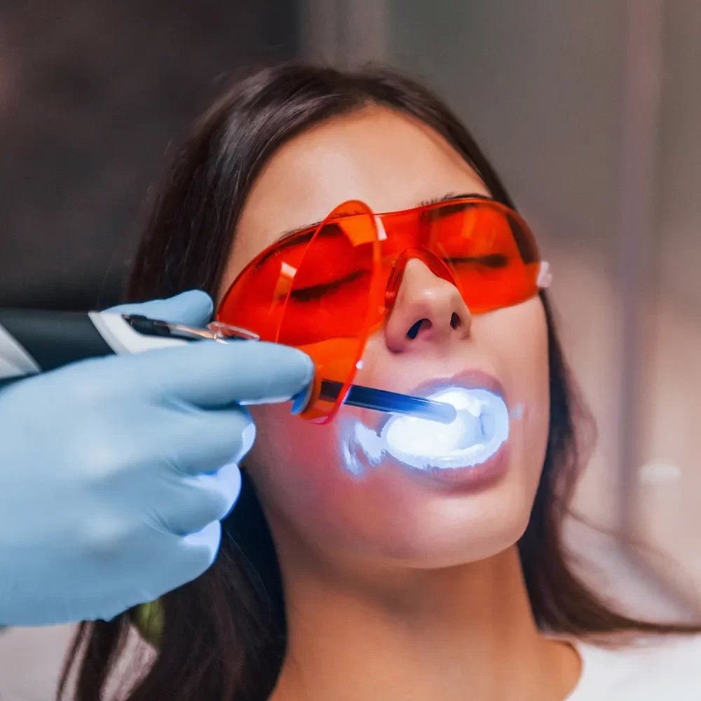 Dental Bonding services in canada