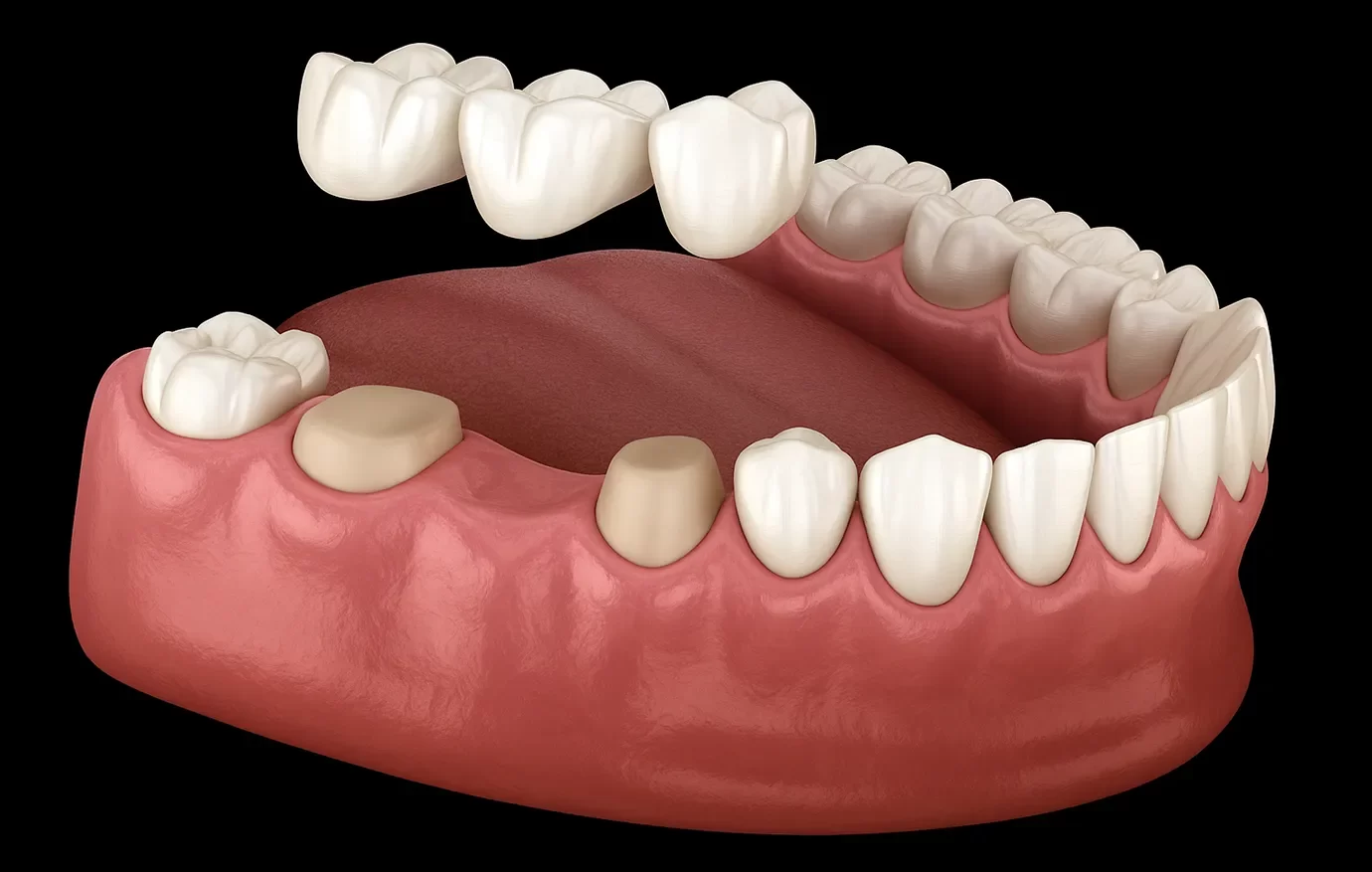 Dental Bridges