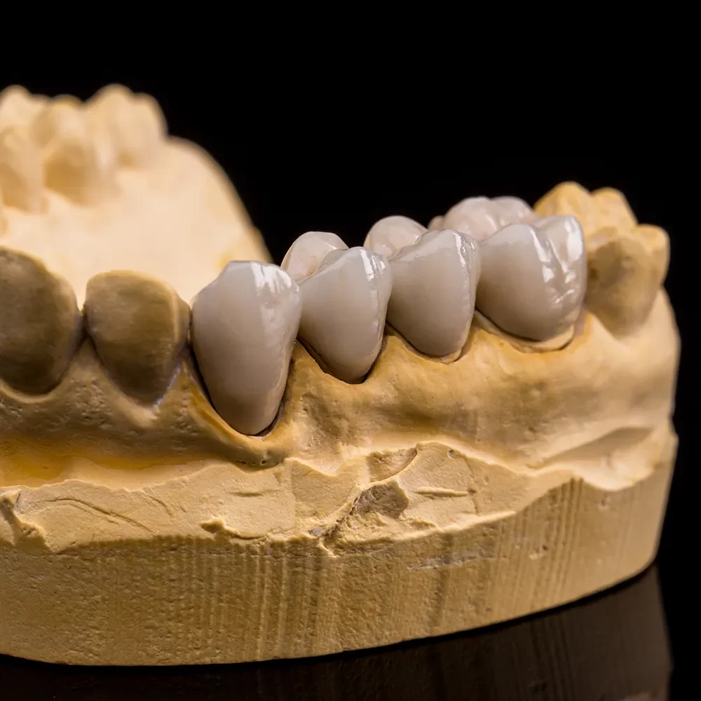 Dental Bridges