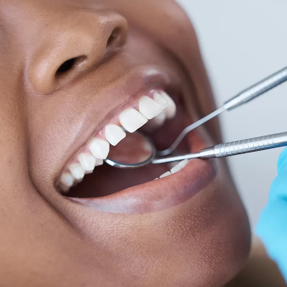 Dental Extraction