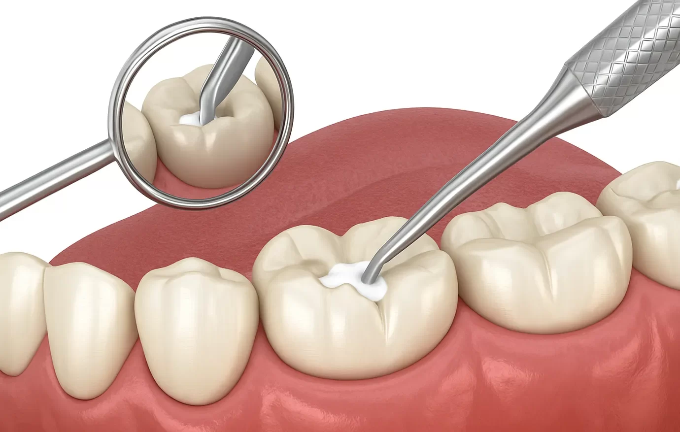 Dental Fillings