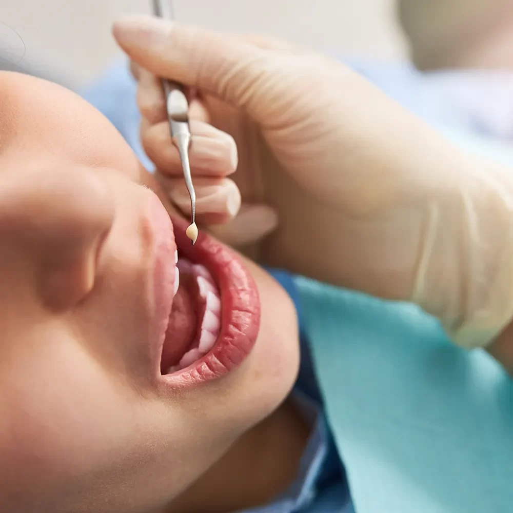 Dental Fillings