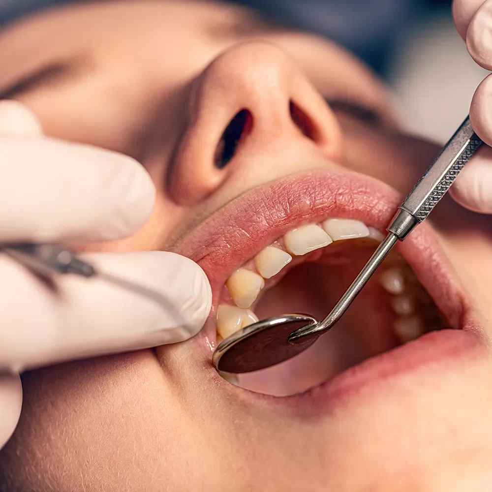 Dental Fillings