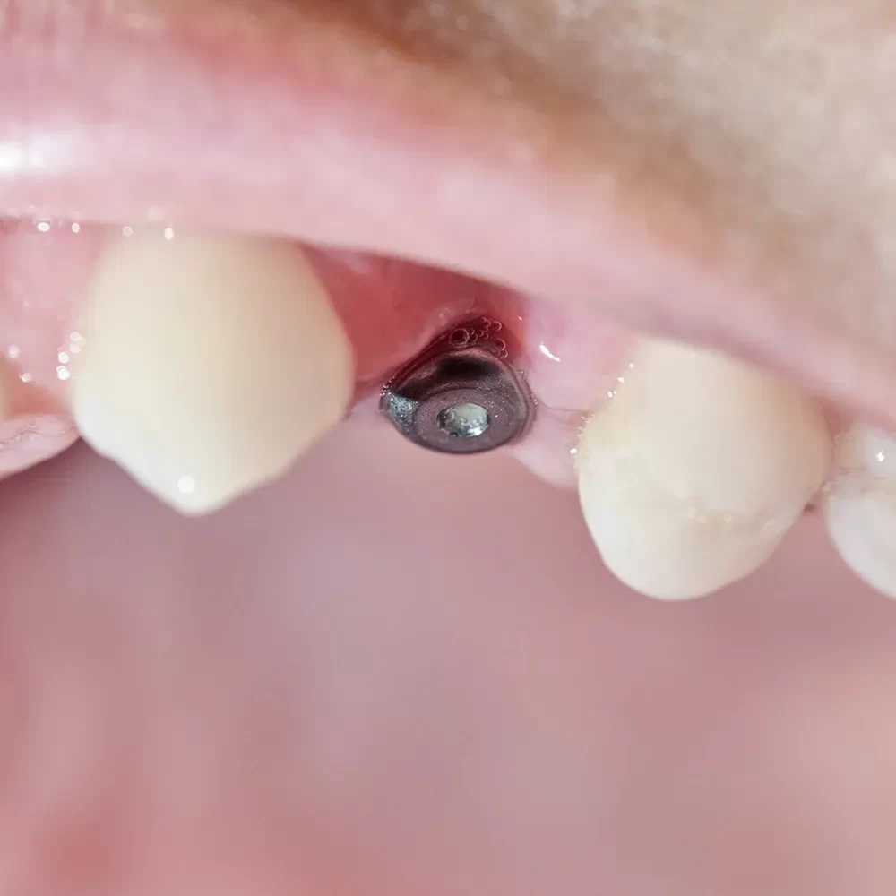 Dental Implants