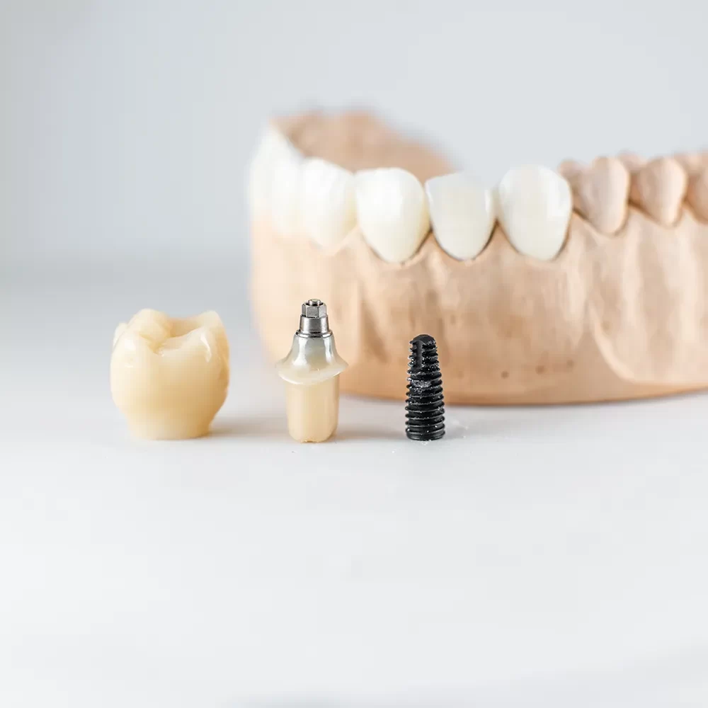 Dental Implants