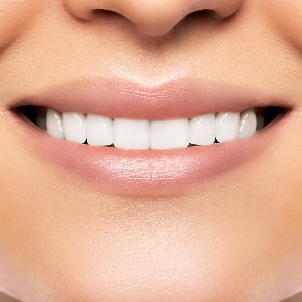 Dental Veneers