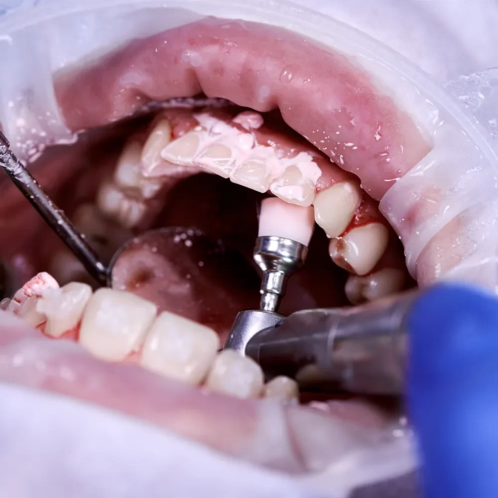 Fluoride Treatments