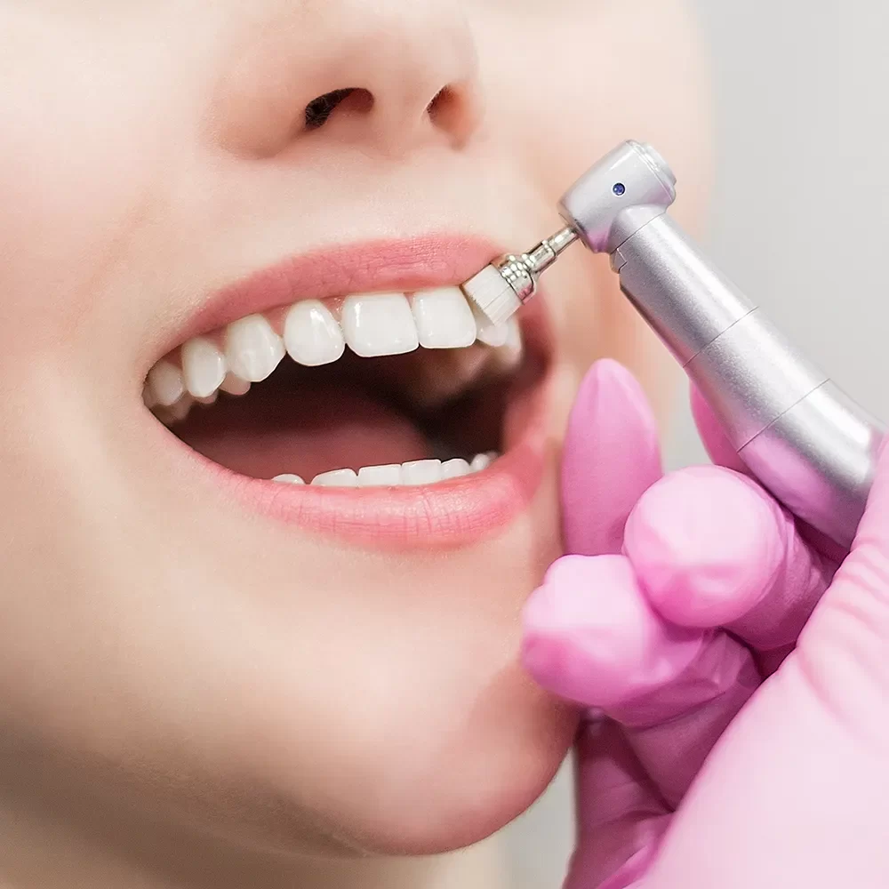 Close-up of a patient having their teeth polished by a dental hygienist at Onyx Dental Clinic, Canada, ensuring a healthy and bright smile.