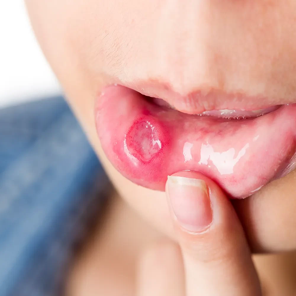 Close-up of a person showing a painful canker sore inside their mouth, highlighting the importance of seeking professional dental care at Onyx Dentistry for treatment and relief.