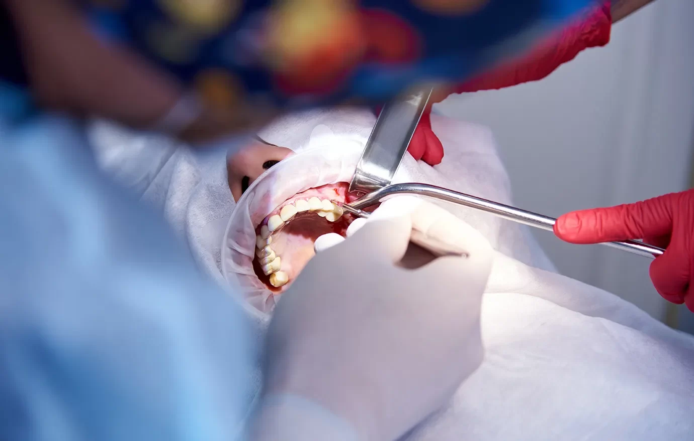 Close-up of a dental professional performing a procedure on a patient, demonstrating the advanced techniques and precise care at Onyx Dentistry in Vaughan.