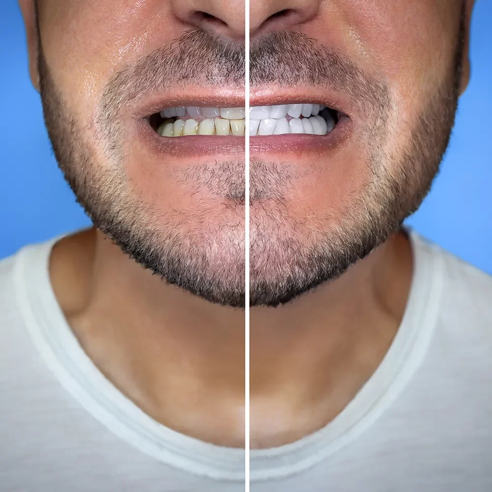 Teeth Whitening