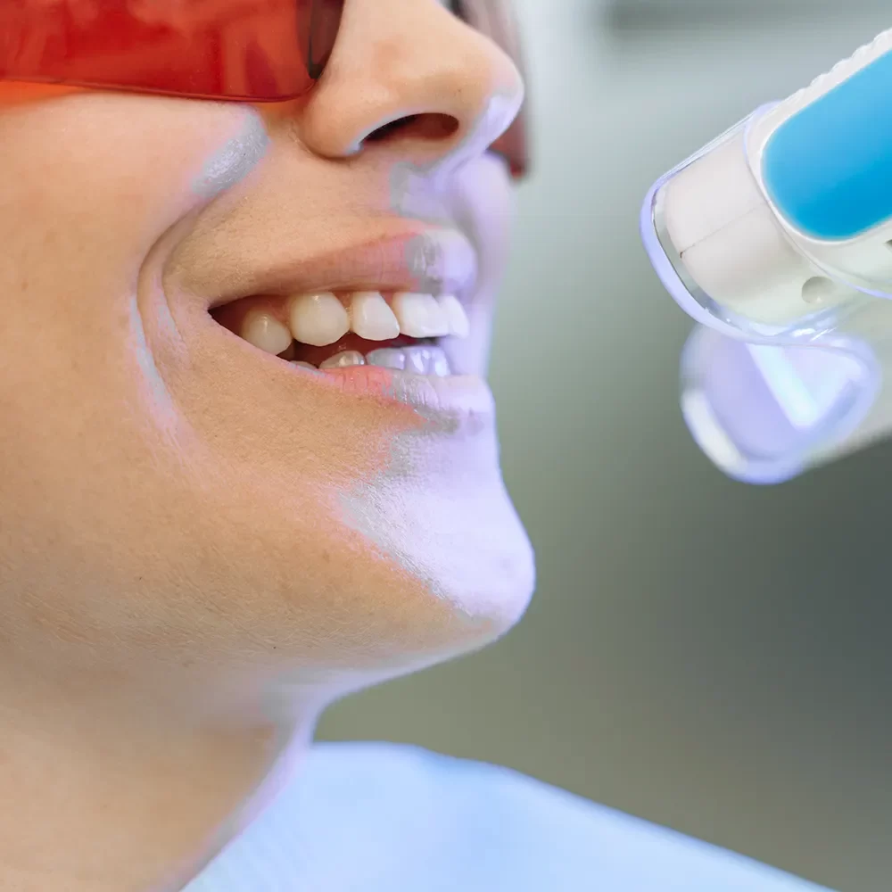 Teeth Whitening