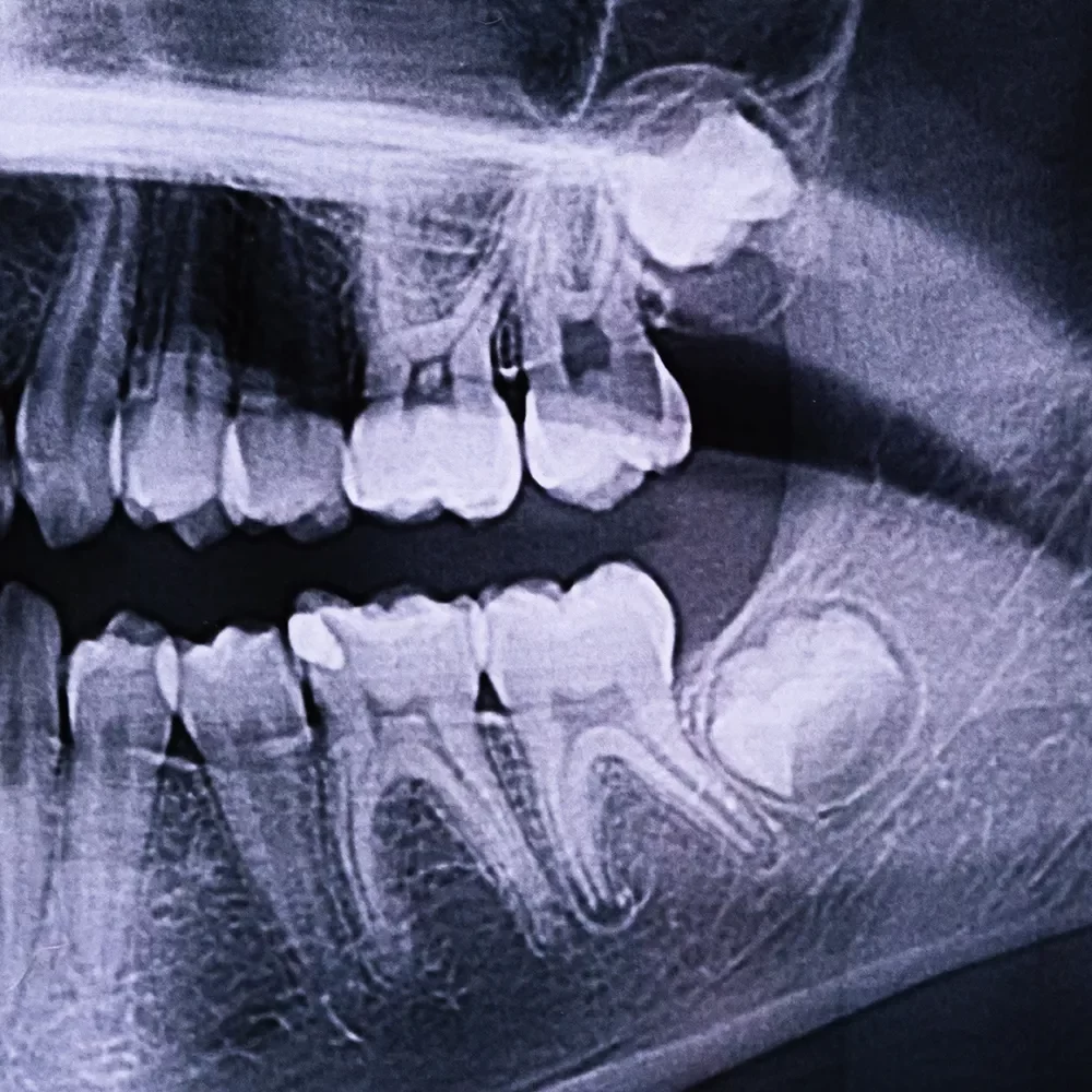 Wisdom Teeth Removal